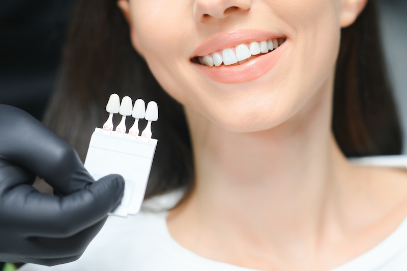 Dental veneers in Grayson