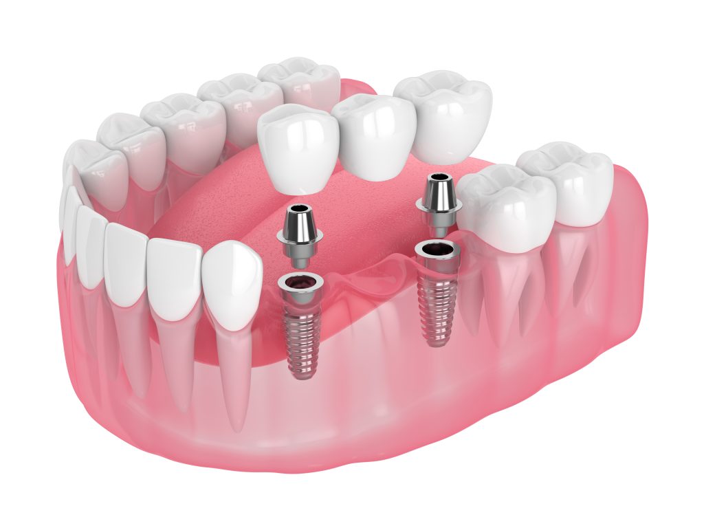 Multiple Missing Teeth Dental Implants