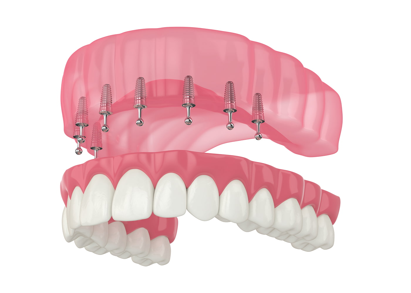 Snap-in Dentures
